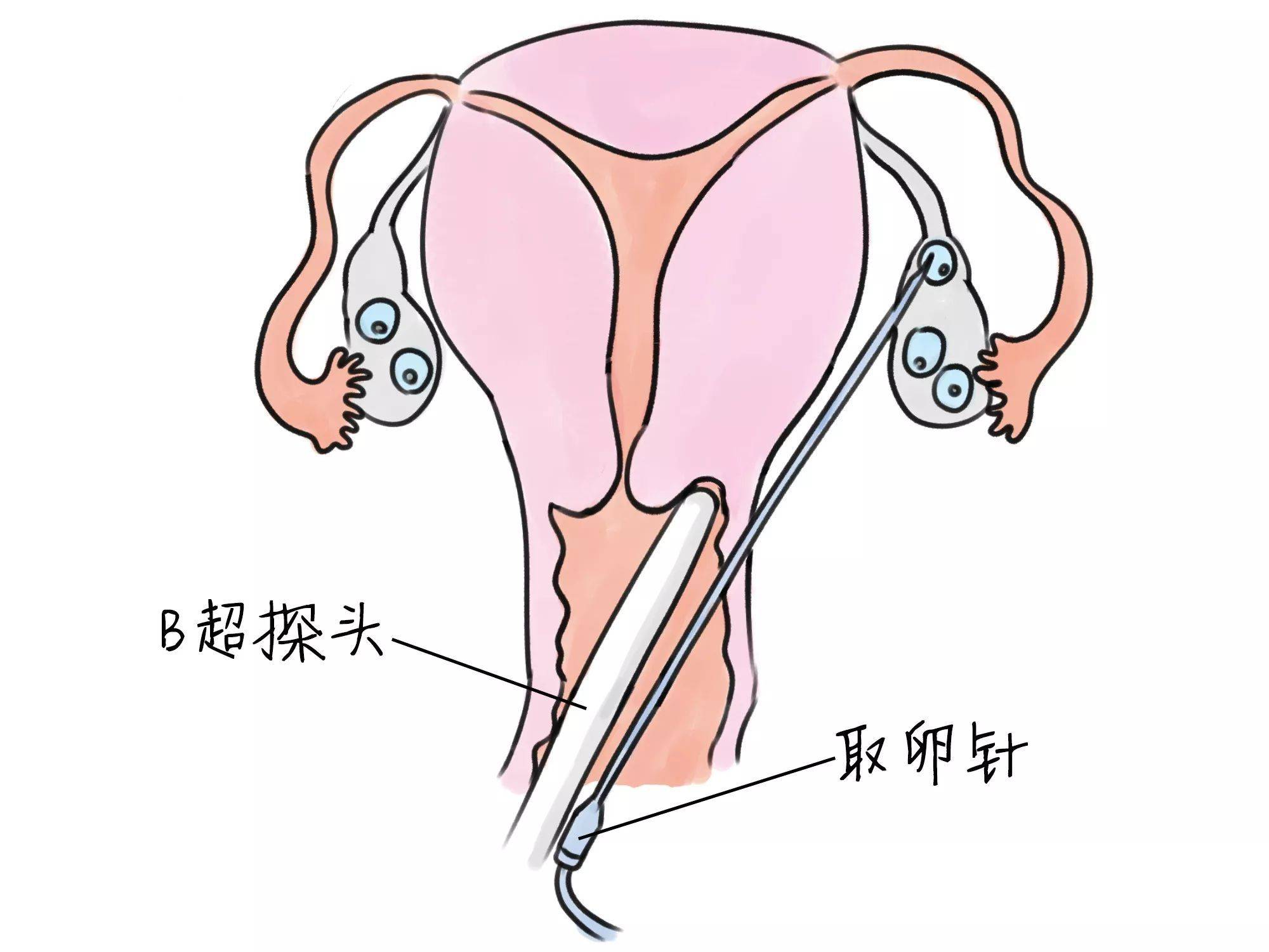 三个月借卵供卵低费用生的宝宝疝气怎么办_三个月借卵供卵低费用生的宝宝疝气怎么办图片